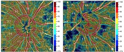 Fundus Changes Evaluated by OCTA in Patients With Cerebral Small Vessel Disease and Their Correlations: A Cross-Sectional Study